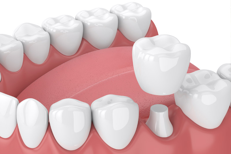 Dental Crowns in Hicksville & Farmingdale