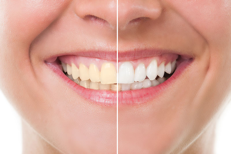 Teeth Whitening in Hicksville & Farmingdale
