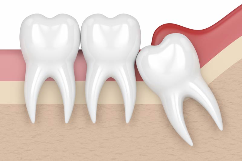 Wisdom Tooth Removal in Hicksville & Farmingdale