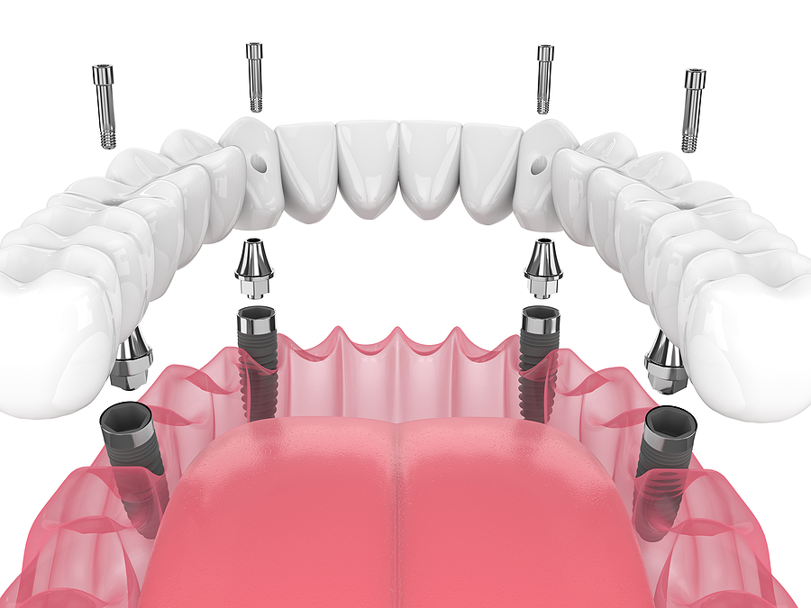 Revolutionizing Dental Restoration: A Comprehensive Guide to All-on-4 Implants