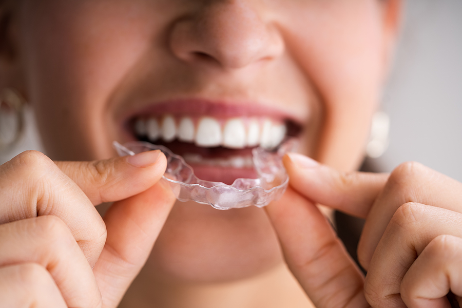 Invisalign: The what, when, and how