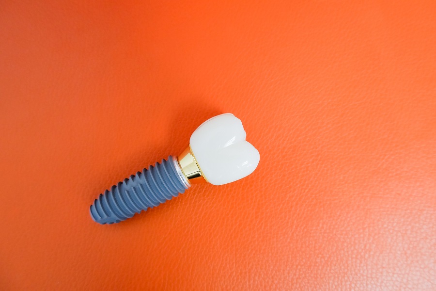 Dental Implant Placement After Traumatic Tooth Expulsion