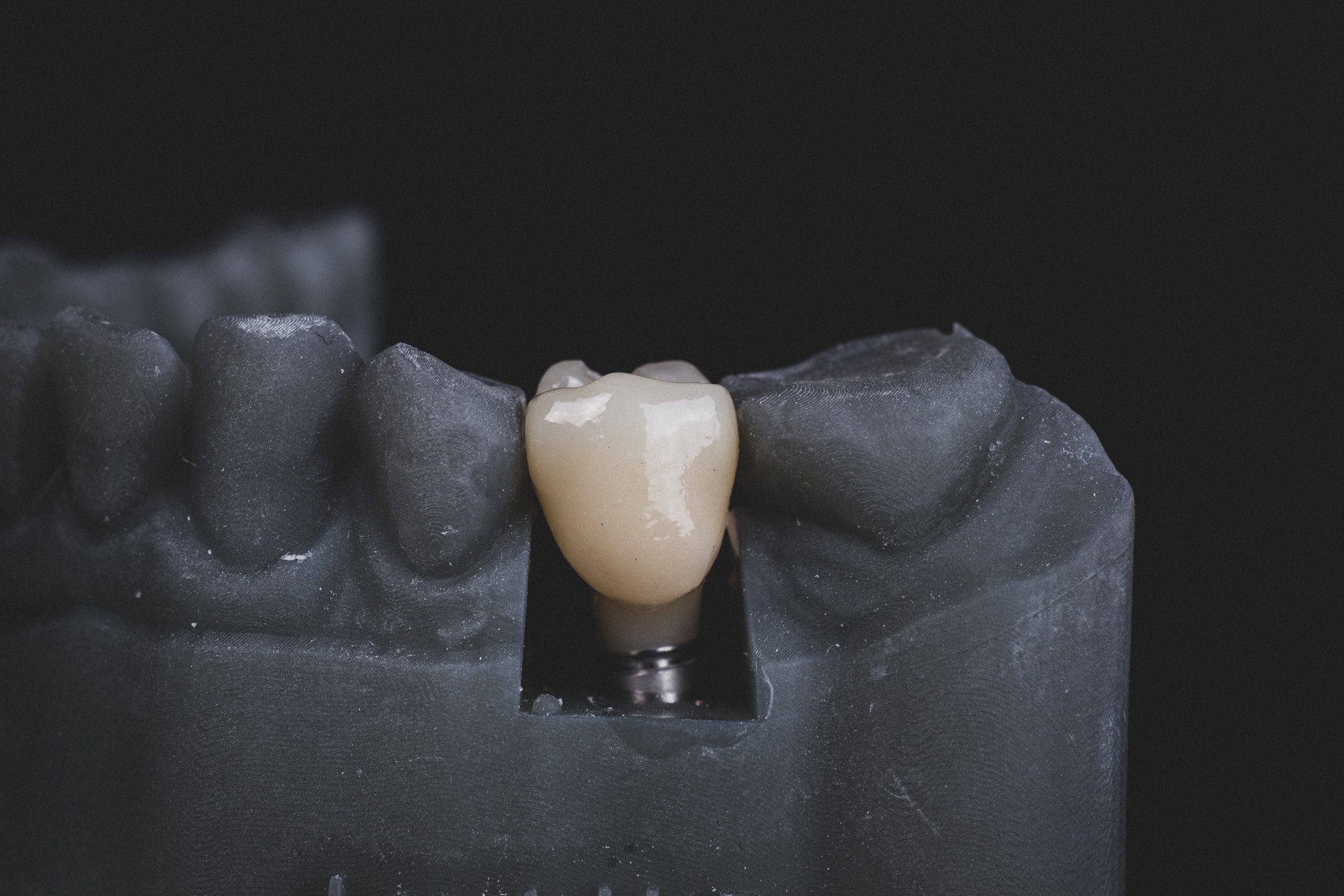 Dental Implants: Transforming Smiles and Lives with Lasting Benefits